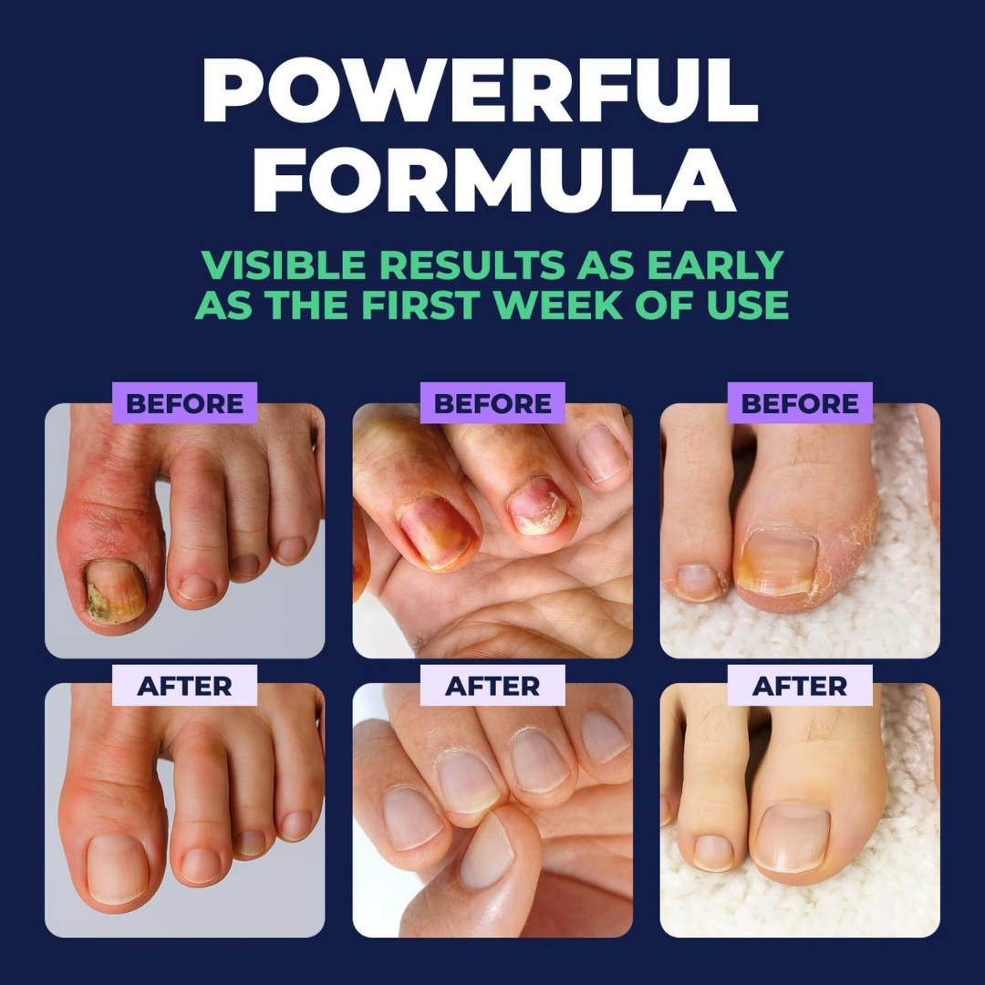 Antifungal Nail Repair Solution