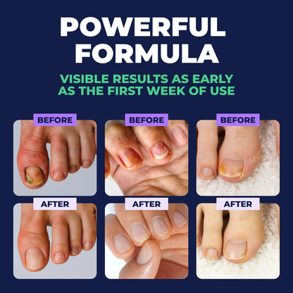 Antifungal Nail Repair Solution