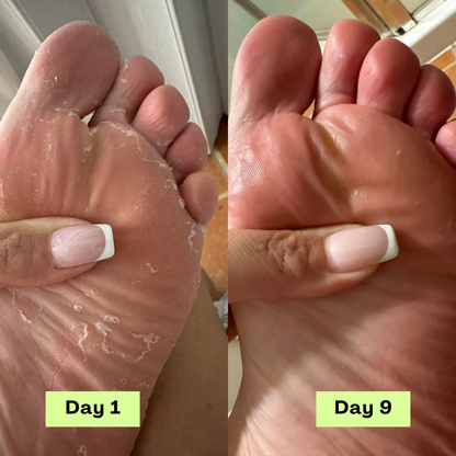 Loravey® AntiFungal Relief Soap Bar