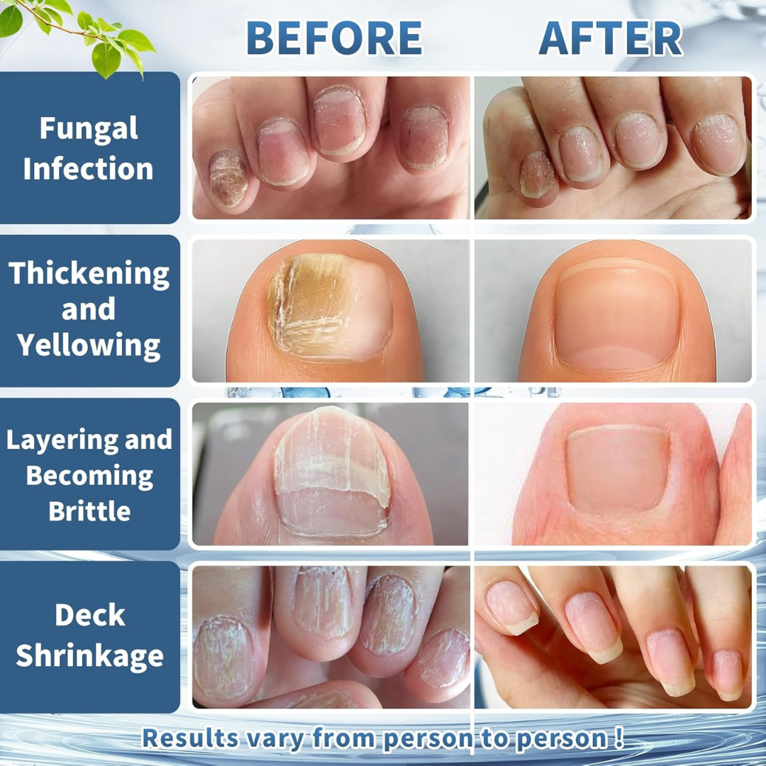 Antifungal Nail Repair Solution